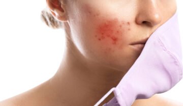 Breakout Skin: Causes, Treatment, and Prevention